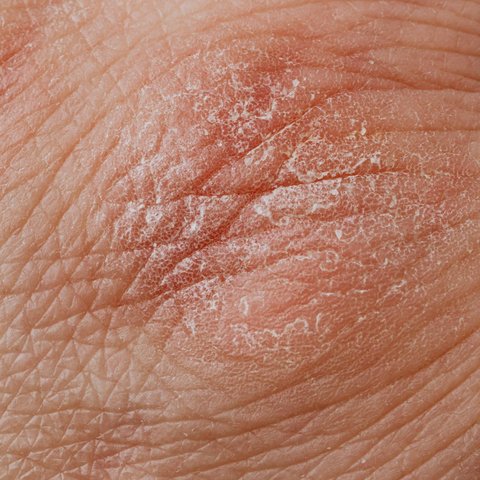 ilustrasi kulit kering