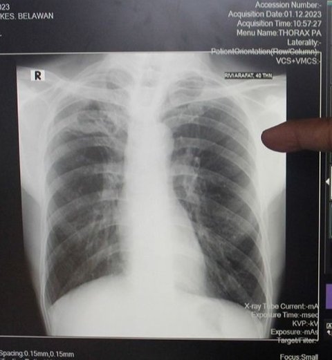 Dokter Rehab Medik RSUP Persahabatan sarankan latihan batuk efektif dengan metode huff cough untuk mempercepat pemulihan pasien tuberkulosis (TBC) dan meningkatkan kualitas hidup.
