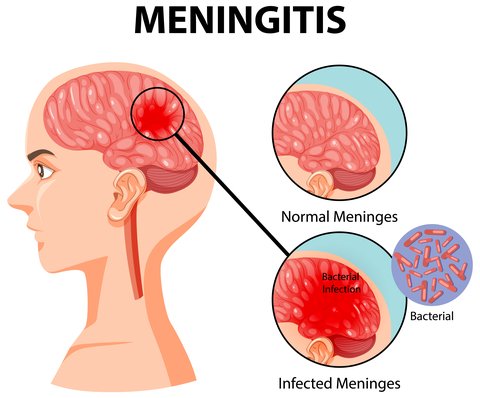 Ilustrasi Meningitis