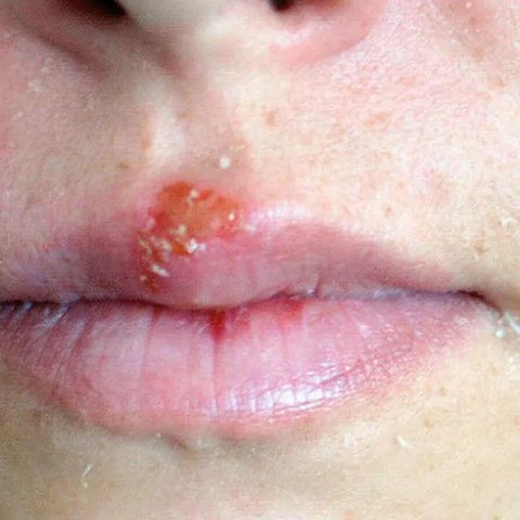 Herpes