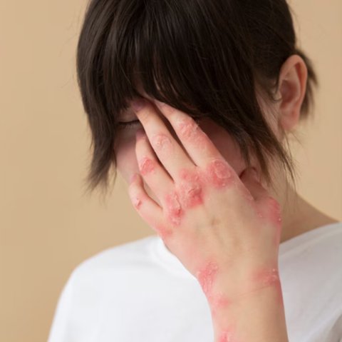 Steven Johnson Syndrome: Panduan untuk Pasien dan Keluarga dalam Proses Diagnosa