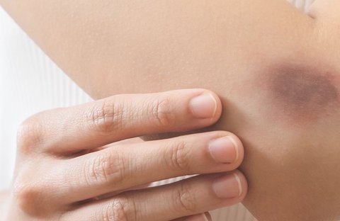 Tubuh Tiba-tiba Memar, Mungkin Kamu Kurang Vitamin Ini