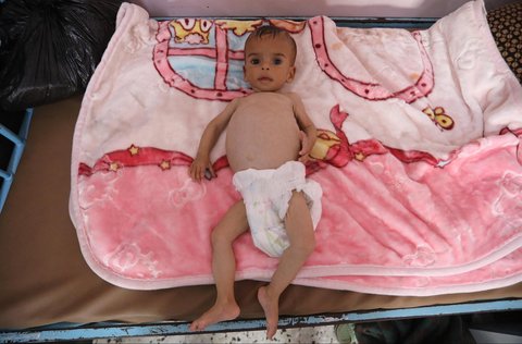 Sila, bayi berusia 11 bulan yang kekurangan gizi terbaring di tempat tidur di Rumah Sakit Nasser di Khan Yunis, Jalur Gaza selatan, Kamis (24/07/2025).