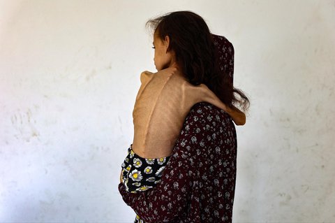 Mariam Dawwas, gadis Palestina berusia sembilan tahun yang kekurangan gizi, digendong oleh ibunya di lingkungan Rimal di Kota Gaza, Sabtu (02/08/2025).  Organisasi Kesehatan Dunia (WHO) memperingatkan pada 27 Juli bahwa malnutrisi telah mencapai