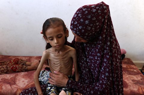 Mariam Dawwas, gadis Palestina berusia sembilan tahun yang kekurangan gizi, digendong oleh ibunya di lingkungan Rimal di Kota Gaza, Sabtu (02/08/2025).  Organisasi Kesehatan Dunia (WHO) memperingatkan pada 27 Juli bahwa malnutrisi telah mencapai
