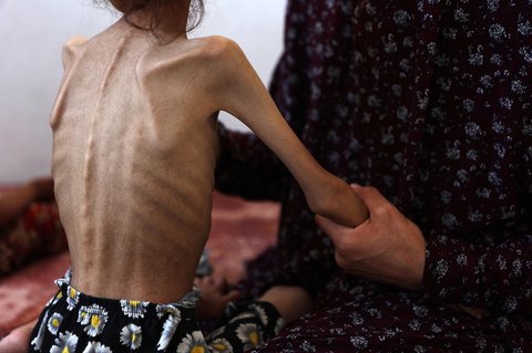 Mariam Dawwas, gadis Palestina berusia sembilan tahun yang kekurangan gizi, digendong oleh ibunya di lingkungan Rimal di Kota Gaza, Sabtu (02/08/2025).  Organisasi Kesehatan Dunia (WHO) memperingatkan pada 27 Juli bahwa malnutrisi telah mencapai