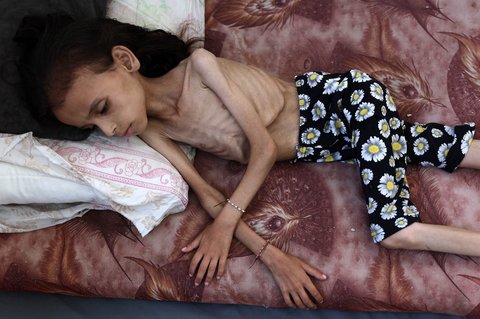 Mariam Dawwas, gadis Palestina berusia sembilan tahun yang kekurangan giz di lingkungan Rimal di Kota Gaza, Sabtu (02/08/2025).  Organisasi Kesehatan Dunia (WHO) memperingatkan pada 27 Juli bahwa malnutrisi telah mencapai