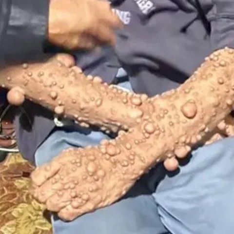 Cerita Pilu Pria di Sukabumi, Puluhan Tahun Tubuh Dipenuhi Kutil Tak Dapat Pengobatan