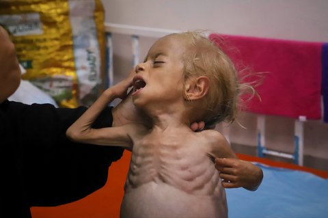 Balita Gaza  bernama Shamm Qudeih yang menderita malnutrisi  di Rumah Sakit Nasser di Khan Younis, Jalur Gaza selatan, (09/08/2025