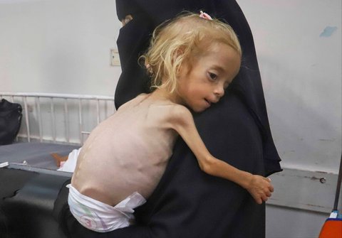 Balita Gaza  bernama Shamm Qudeih yang menderita malnutrisi  di Rumah Sakit Nasser di Khan Younis, Jalur Gaza selatan, (09/08/2025