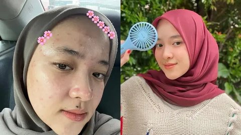 Potret Nissa Sabyan Percaya Diri Tampilkan Wajah Berjerawat Tanpa Makeup, Bikin Pangling