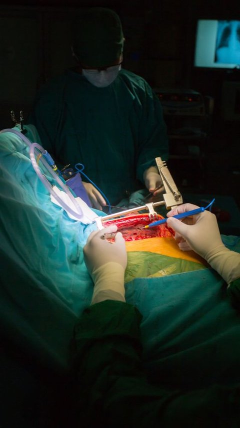 Operasi Bypass Jantung Koroner (CABG) Pertama di Purwabeka Sukses Ditangani RS EMC Cikarang