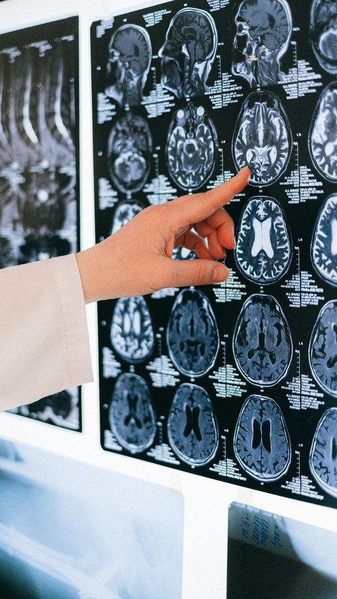 Gejala Stroke Biasanya Muncul Secara Mendadak Berupa Rasa Kesemutan di Satu Sisi