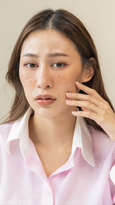 Don't Squeeze, Follow Safe Steps to Clean Acne