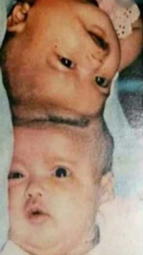 Remember Yuliana-Yuliani, the Conjoined Twins with Joined Heads who Successfully Underwent Surgery? Their Fate Now …