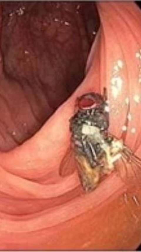 Doctor Finds Live Fly in Man's Colon During Medical Check-Up