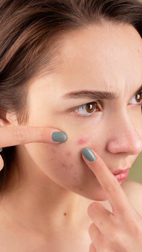 How To Remove Pimples Naturally and Permanently For Teenage Girls