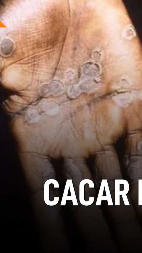 SEMENIT PAHAM: Waspada Cacar Monyet, Kenali Gejalanya Sekarang!