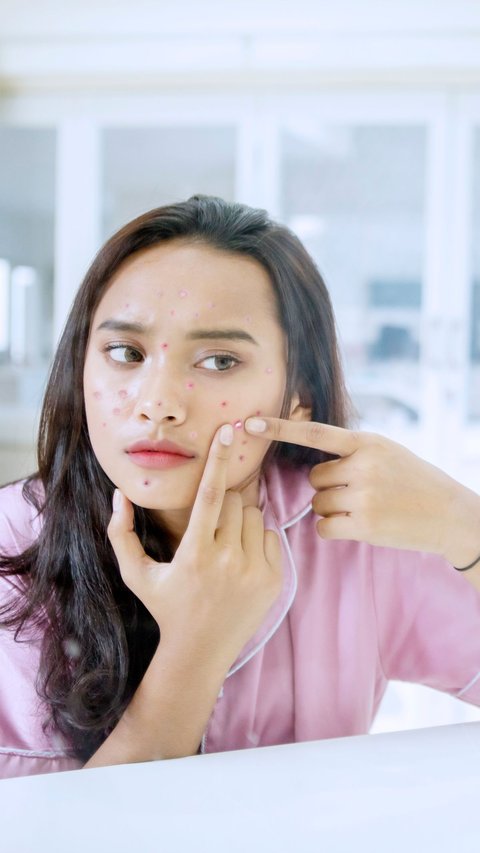 Examining the Root of Hormonal Acne Problems, Here's How to Overcome It