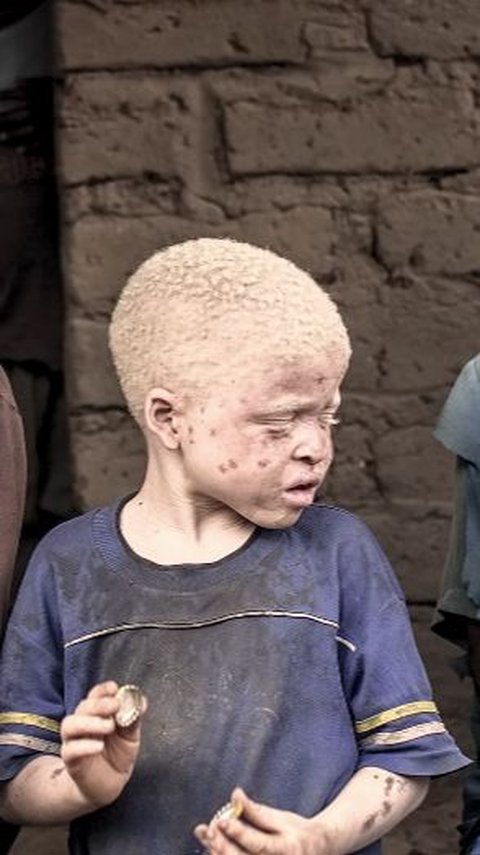 Potret Kampung Albino Tersembunyi di Tanzania, Begini Kondisinya