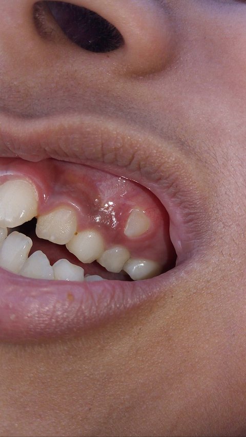 Crooked Teeth: Causes, Dangers, and Prevention