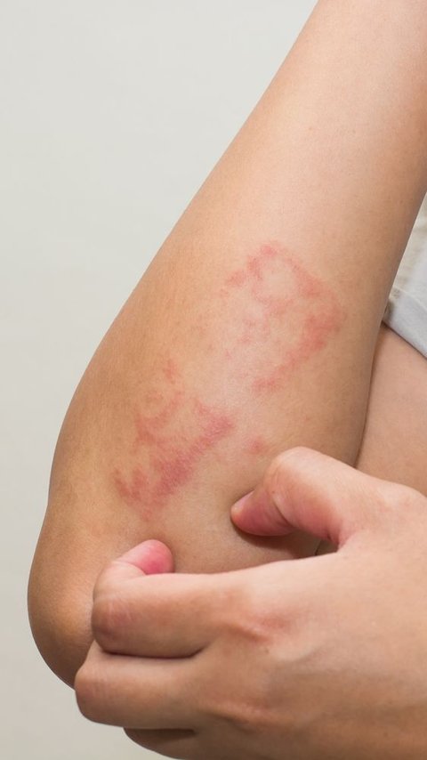 Penyebab Dermatitis Seboroik Beserta Gejala dan Cara Mengobatinya