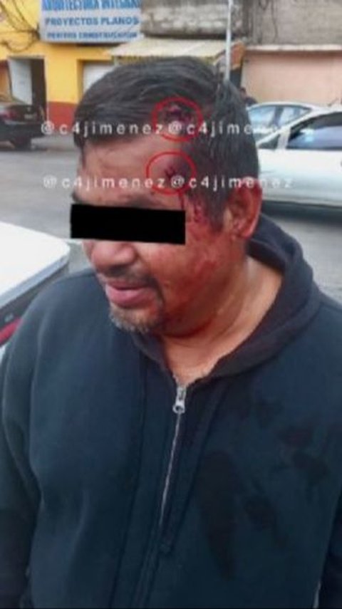 This Man's Head Bounced the Bullet that Hit Him Twice
