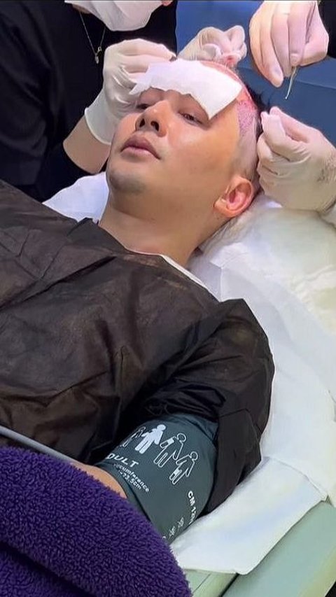Potret Kiki Farrel Operasi Transplantasi Rambut di Turki, Habis Berapa Duit?