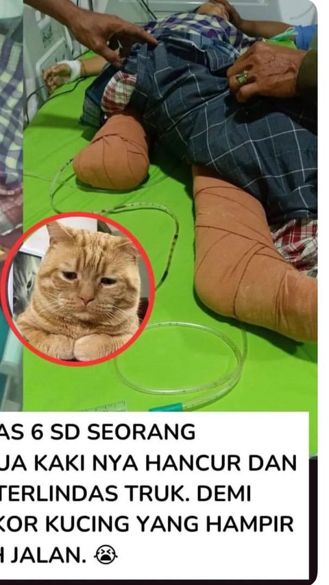 Kisah Viral Bocah Nabila Febrianti, Kaki Diamputasi Gara-Gara Selamatkan Kucing dari Kecelakaan