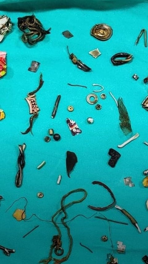Doctors Find Earphones, Lockets, Screws During Patient's Stomach Surgery