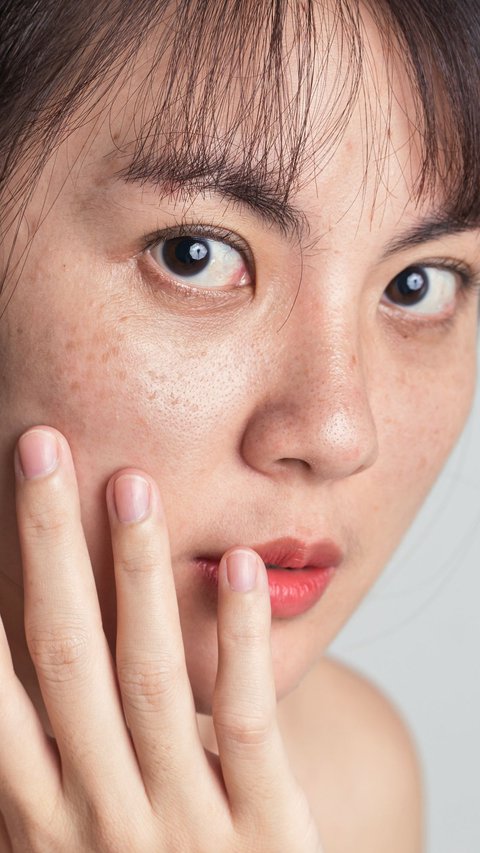 Teenage Acne Should Not Be Underestimated, Take Care to Avoid Scarring