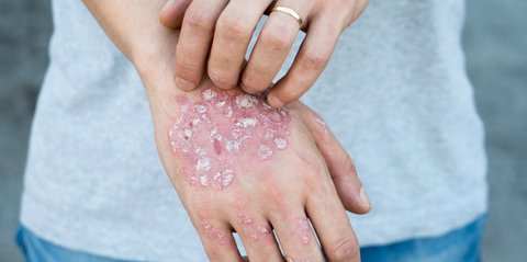 Inovasi Klinik Kecantikan Hadirkan Treatment Psoriasis untuk Keluarga, Cek Fakta Penyakit Ini Yuk!