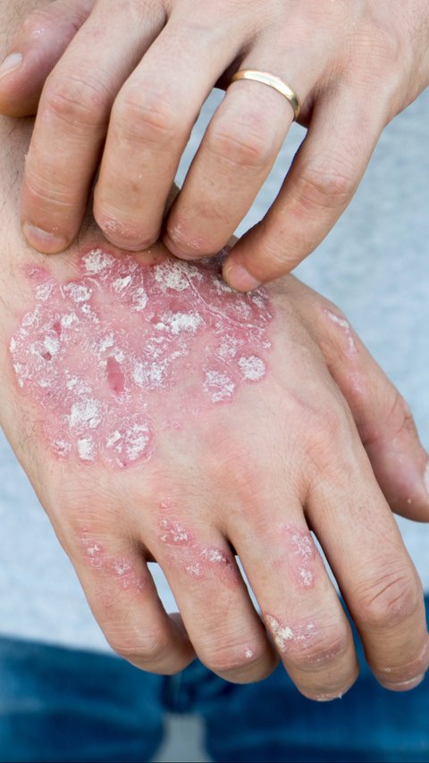 Inovasi Klinik Kecantikan Hadirkan Treatment Psoriasis untuk Keluarga, Cek Fakta Penyakit Ini Yuk!