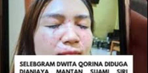 Polisi Tetapkan Mantan Suami Siri Selebgram di Lombok jadi Tersangka Penganiayaan