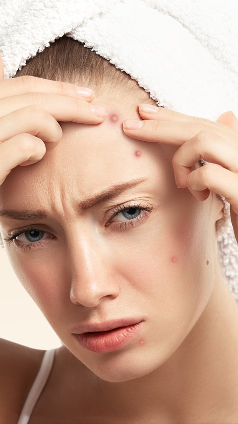 Acne Gone Without Skincare? Here are 9 Natural Ways to Try