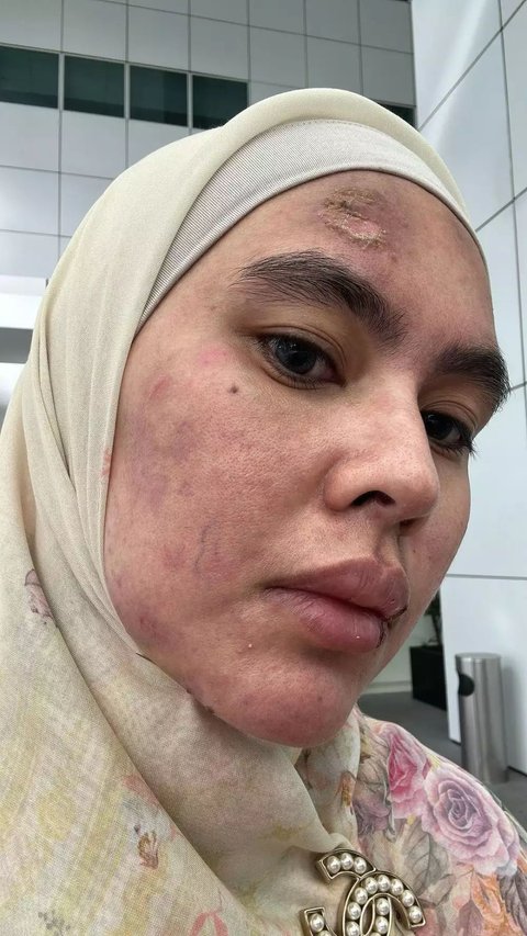 Muka Sempat Melepuh, Potret Terkini Wajah Kartika Putri yang Manglingin