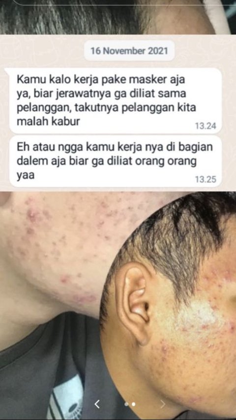 Story: Employees Asked to Wear Masks When Meeting Customers because This Acne Makes Them Uncomfortable