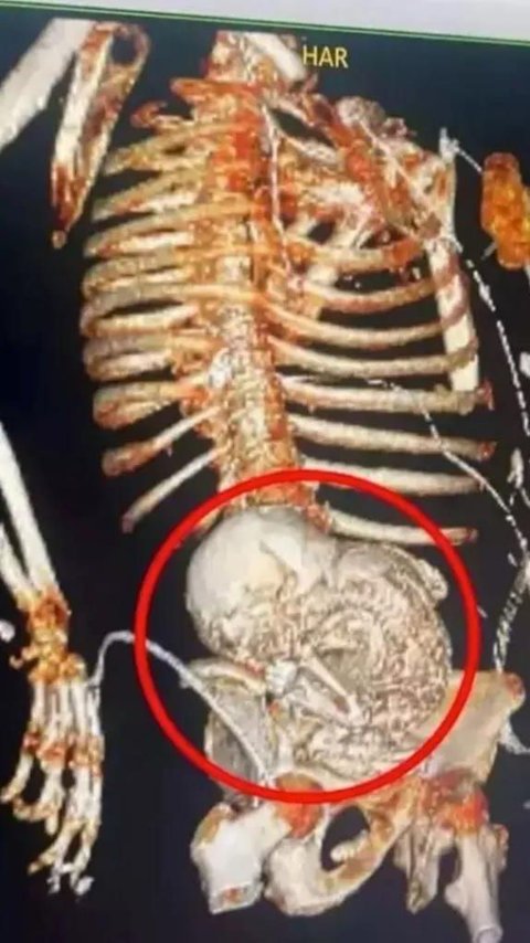 Enlarged Stomach Mistaken for Cancer, 81-Year-Old Grandmother Turns Out to be 'Pregnant' for 50 Years Until the Fetus Fossilized