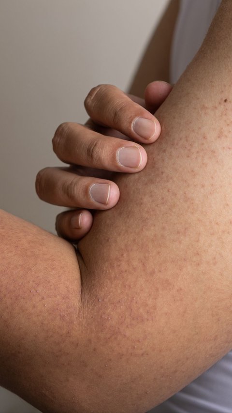 Pimples on the Arm Skin Should Not Be Ignored, Could be a Serious Problem