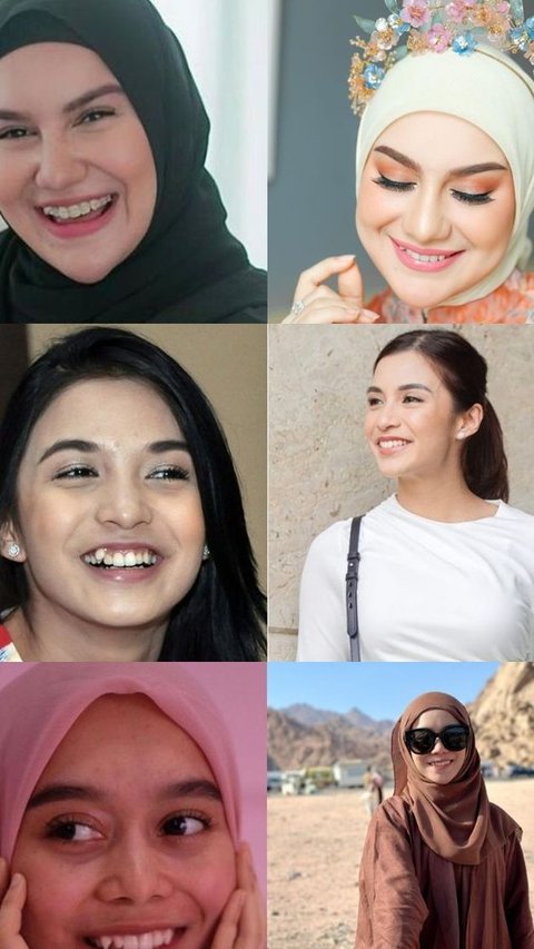 Transformasi 6 Artis Setelah Hilangkan Gigi Gingsul, Ini Potret Sebelum dan Sesudahnya