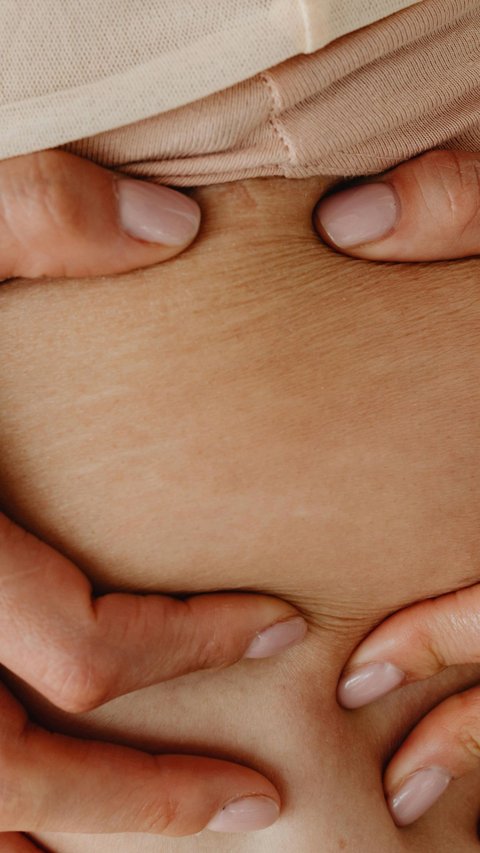 How to Remove Stretch Marks on Skin with Powerful Solutions!