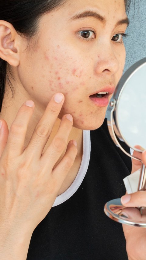 3 Causes of Acne When Going to the Gym Frequently