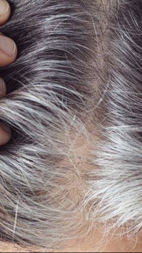 Causes of Gray Hair at the Age of 20s, One of Them is Smoking
