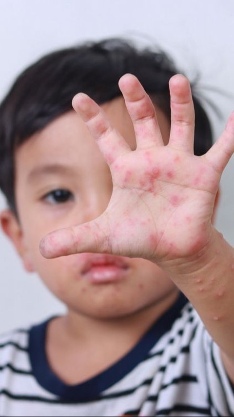 Waspada Penularan Flu Singapura Pada Anak Cenderung Meluas Saat Mudik