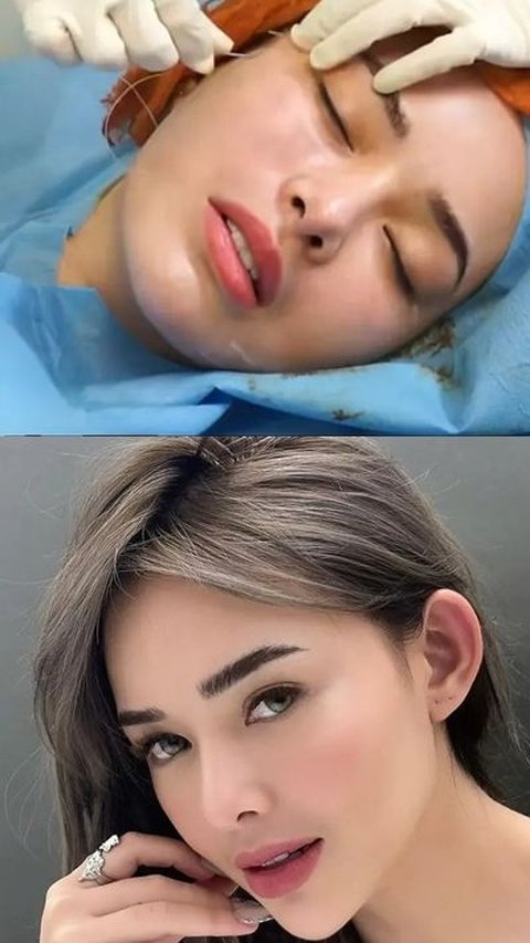 Potret Amanda Manopo Perawatan Tarik Benang Wajah, Begini Hasilnya