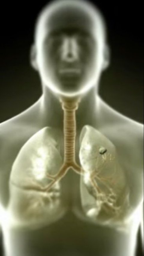 Tuberculosis Outbreak Causes Health Emergency in California