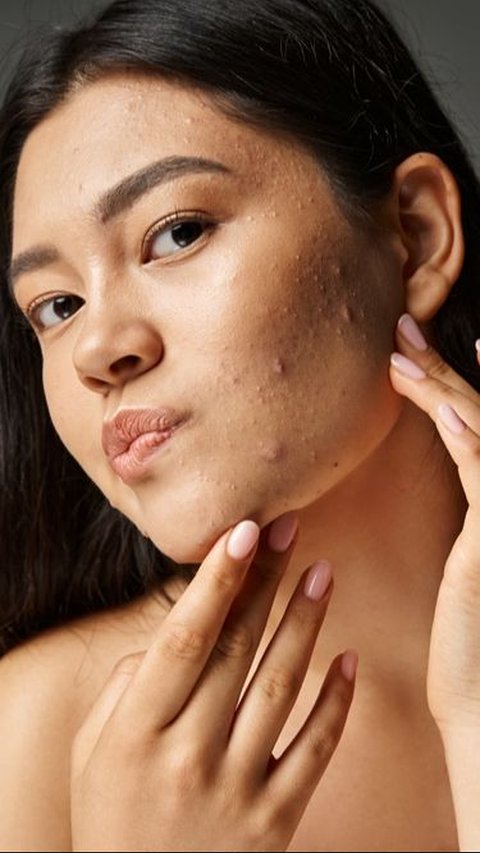 Important Skincare Steps When Your Skin is Acne-Prone