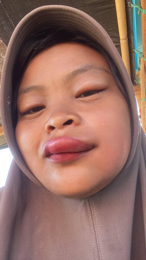 Because Riding a Motorcycle Without Wearing a Mask, This Girl's Lips Ended Up Swollen by a Bee Sting