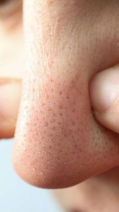 Natural and Easy Way to Get Rid of Blackheads, Just with 1 Kitchen Ingredient