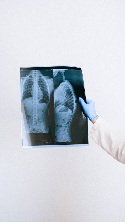 Dokter Spesialis: Lewat Ngobrol, Penderita TBC Aktif Bisa Menularkan ke Lawan Bicara